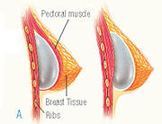 Dr. Mark Prysi, Breast Implants